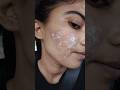 Transforming My Skin Acne Scars Journey Laser Treatment Skincare Shorts