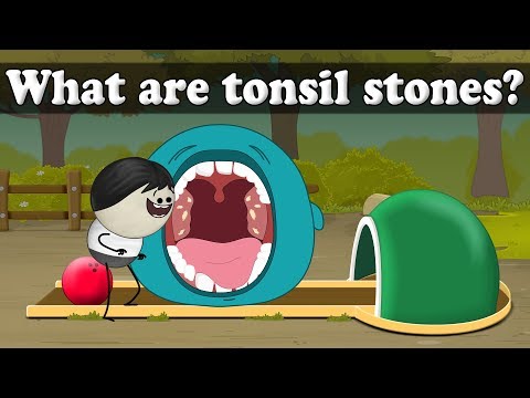 扁桃腺結石とは？| 扁桃腺結石とは？ (What are tonsil stones? | #aumsum)