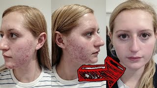 How to Get Rid of Red Acne Marks || Acne Treatment On Face