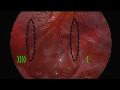 Inferior Epigastric Vessel Identification