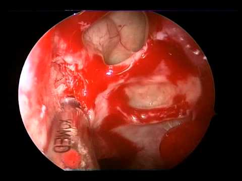 Sphenoid Mucocele