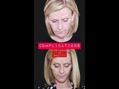 YOU will probably have a facelift complication￼...