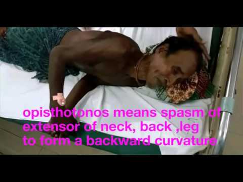 download lagu mp3 mp4 Risus Sardonicus, download lagu Risus Sardonicus gratis, unduh video klip Risus Sardonicus