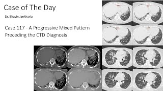 Case of the Day - 117 - 2025 10 13 - A Progressive Mixed Pattern Preceding the CTD Diagnosis