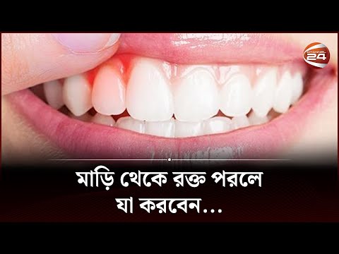 মাড়ি ফুলে যাচ্ছে বা মাড়ি থেকে রক্ত পরছে? কি করবেন? | Oral Gum Infection | Oral Health | Channel 24