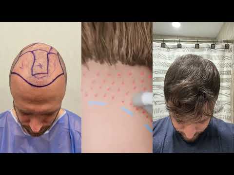 How Does a Hair Transplant Work? Step-by-Step Guide - Affirmative Hair Solutions