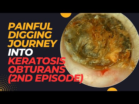 PAINFUL Digging Journey Into Keratosis Obturans (2nd Episode)
