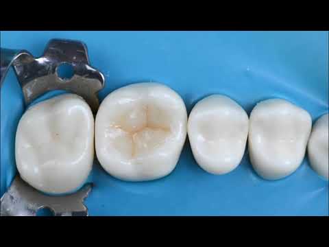 Anatomy for upper molar