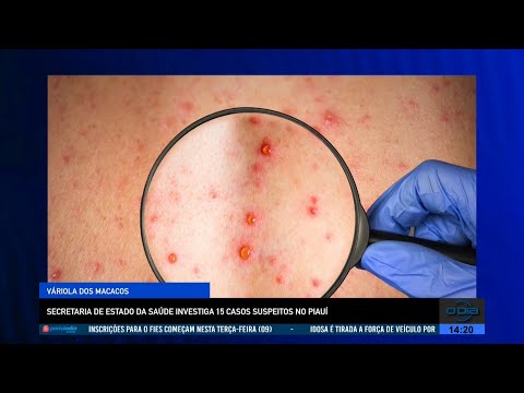 Secretaria de Estado da Saúde investiga 15 casos suspeitos de Varíola dos Macacos 09 08 2022