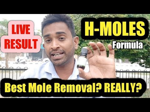Best Mole Removal Cream (H-Moles Formula) REALLY? || Mole Removal on Face
