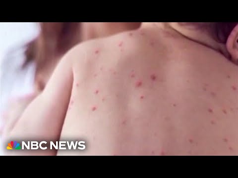 South Carolina measles cases hit new high