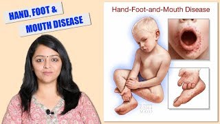 HAND, FOOT, MOUTH DISEASE | SYMPTOMS, DIAGNOSIS, TREATMENT