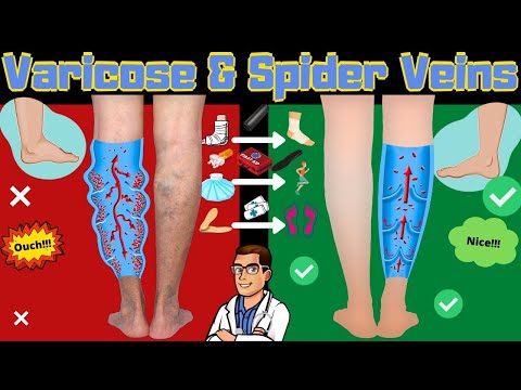 , title : 'Spider Veins in Legs & Varicose Veins Treatment [Causes & Symptoms]'