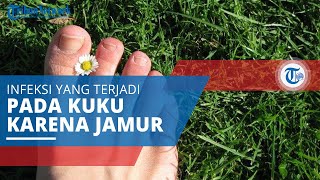 Onikomikosis, Infeksi yang Terjadi pada Kuku Manusia karena Adanya Jamur