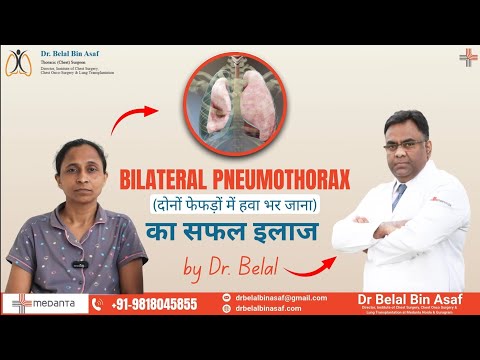 Bilateral Pneumothorax का सफल इलाज | Life-Saving Chest Surgery