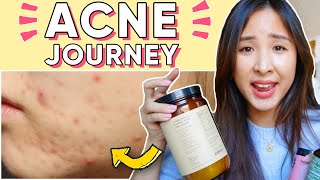 How I Used Food, Supplements & Nutrition to CLEAR My Acne, NATURALLY 😍