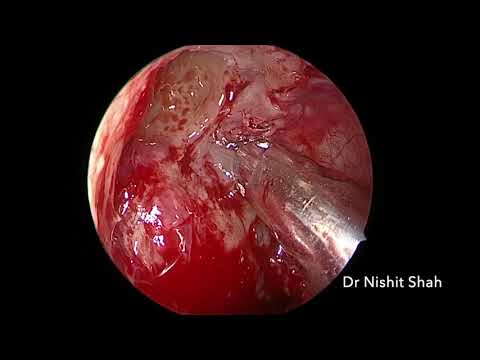 FESS for sinusitis, Dr Nishit Shah