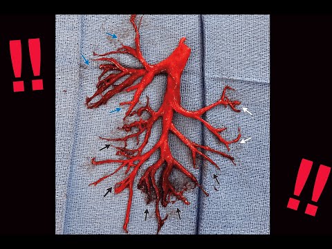 A man coughed out a blood clot in the shape of his right lung: Explained