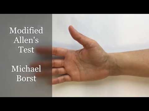 Modified Allen's Test