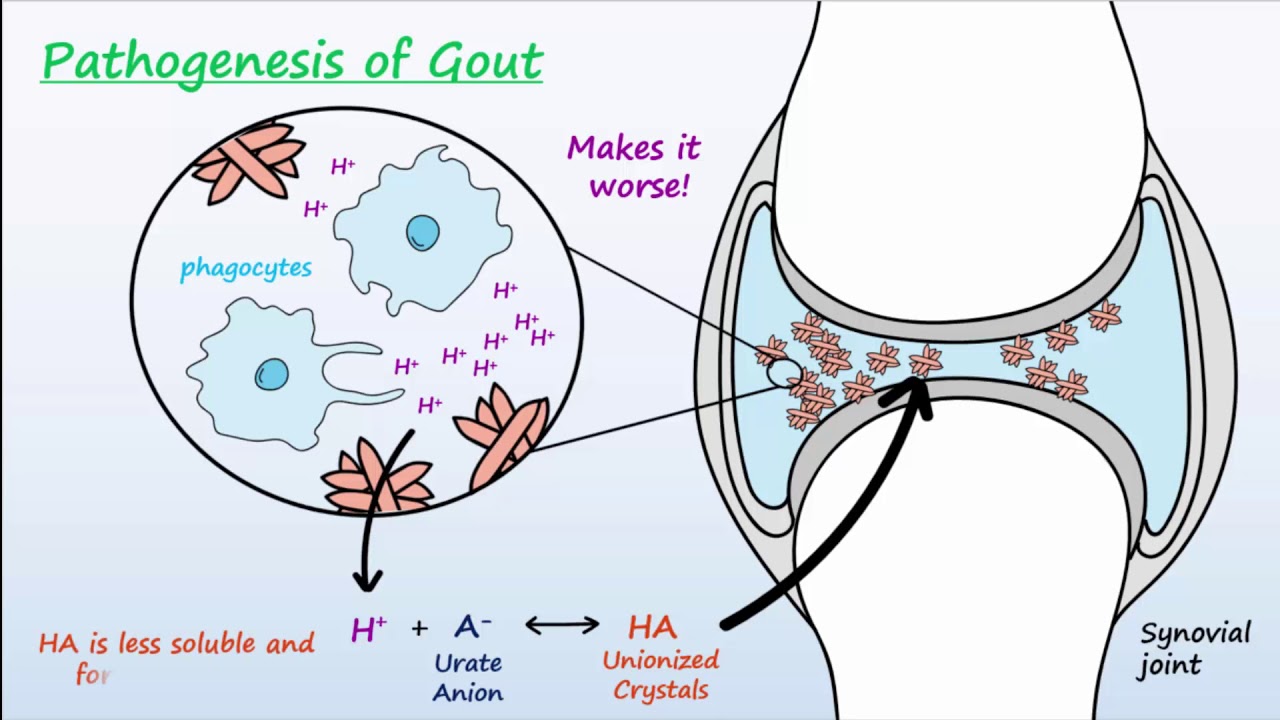 Gout - Mechanisms & Treatment