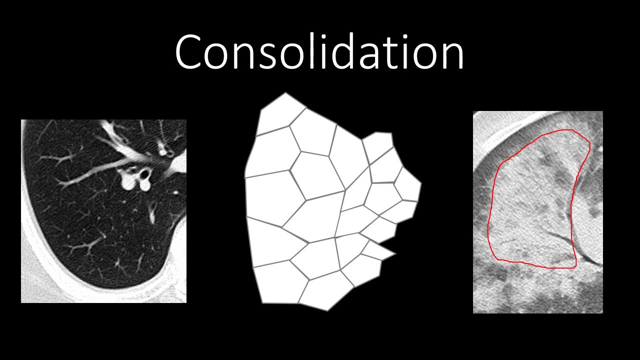 Chest Radiology - Patterns - Airspace