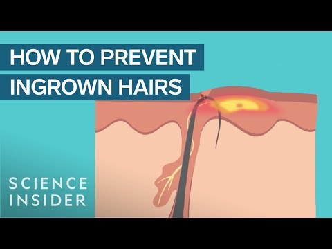 Video: How to Prevent Ingrown Hairs