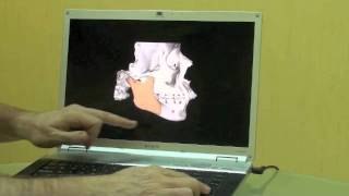 Cirugia Ortognatica- Osteotomía de Obwegesser- Dr Garcia Vega - Clínica MaxiloFacial García Vega