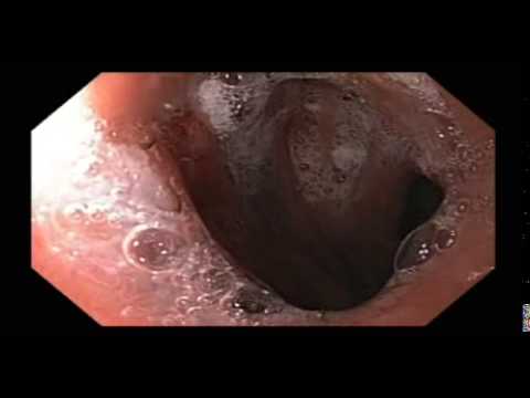 Agrafes gastro-intestinales vues en endoscopie