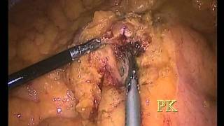 Laproscopic Extended Right Hemicolectomy
