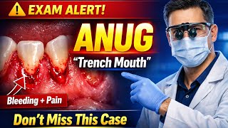 Acute Necrotizing Ulcerative Gingivitis (ANUG) 🦷 Complete Guide