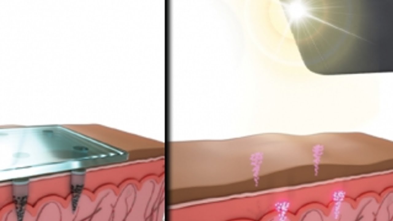 Storing medical information below the skin’s surface - YouTube