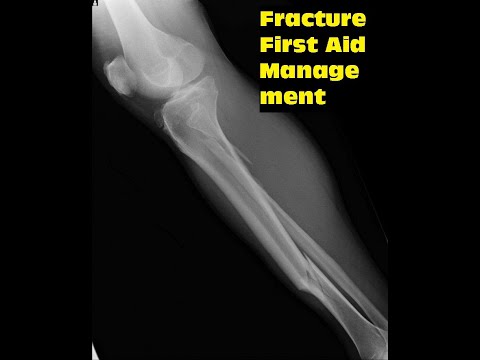 Fracture | Fracture of Bone and First Aid Treatment#bone#viral videos