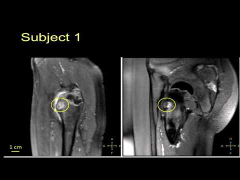 Temple - MRgHIFU treatment of osteoid osteoma in pediatric patients: Preliminary results (2016)