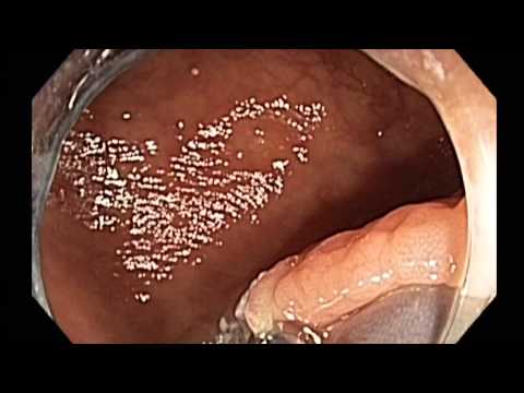 Colonoscopy: EMR of Transverse Colon subtle Serrated Adenoma