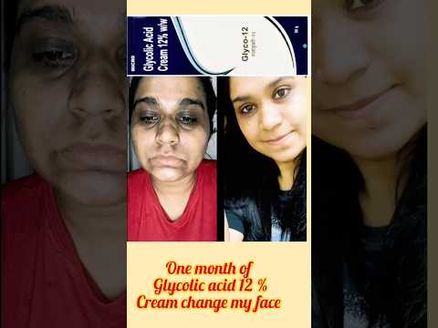 One Month Of Glycolic acid 12% cream change my face #drugstore #glycolicacid #shorts