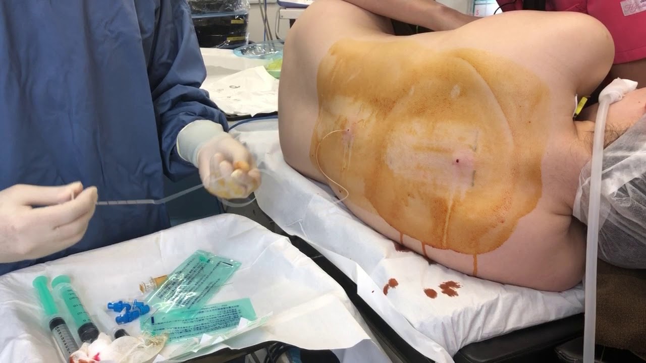 二年間悩んで脂肪吸引を決意する！！背中の脂肪吸引術中劇的変化