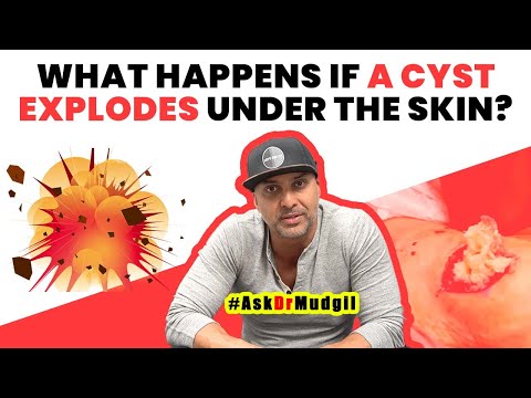 Cyst Explosions