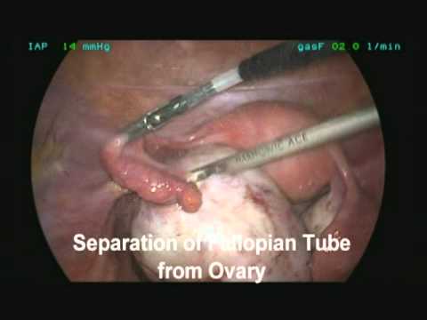 Ovarian Endometrioma - Laparoscopic Management