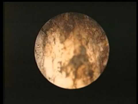 Eiaculazione quando massaggiare la prostata Adenoma prostatico nodulare