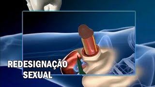 Cirurgia | Redesignação Sexual: Homem - Mulher ᴴᴰ
