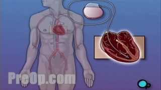 Permanent Pacemaker Implant Surgery PreOp® Patient Education