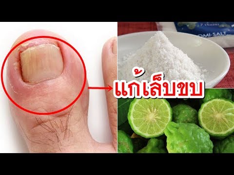 ไม่ว่าจะเป็นไปได้ที่จะอาบน้ำเด็กที่มีแผลเปื่อย รักษากลากที่มือของลูกด้วยนมแม่