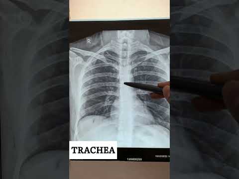 CHEST X-RAY BASICS #xrayclasses #physiotherapy