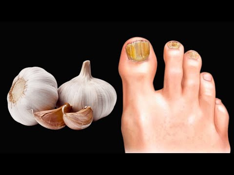 🔥Eliminates nail fungus instantly. The best remedy against fungi and parasites. Benefits of Garlic.
