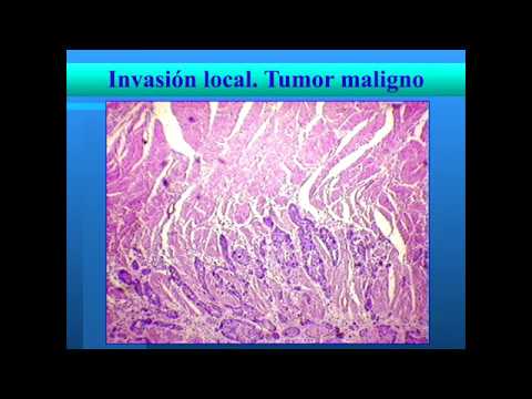 Neoplasias - Características de las neoplasias benignas y malignas