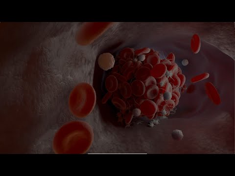 Beating a deadly blood clot: How thrombectomy saved Marnie's life