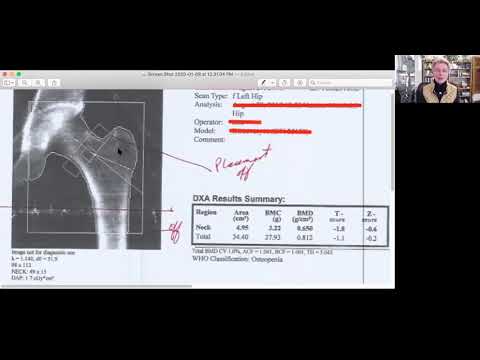 Bone Density Test Errors: DXA Case Study #1
