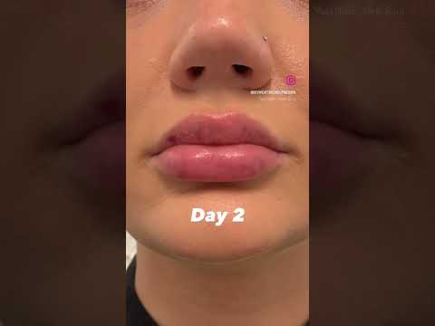Lip Filler Progress Photos