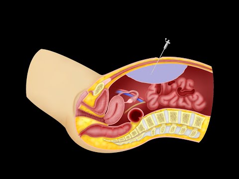 Laparoscopy - Carbon Dioxide Insufflation and First Trocar Insertion