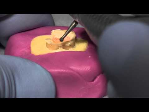 Removing  Gutta Percha for a Post and Core